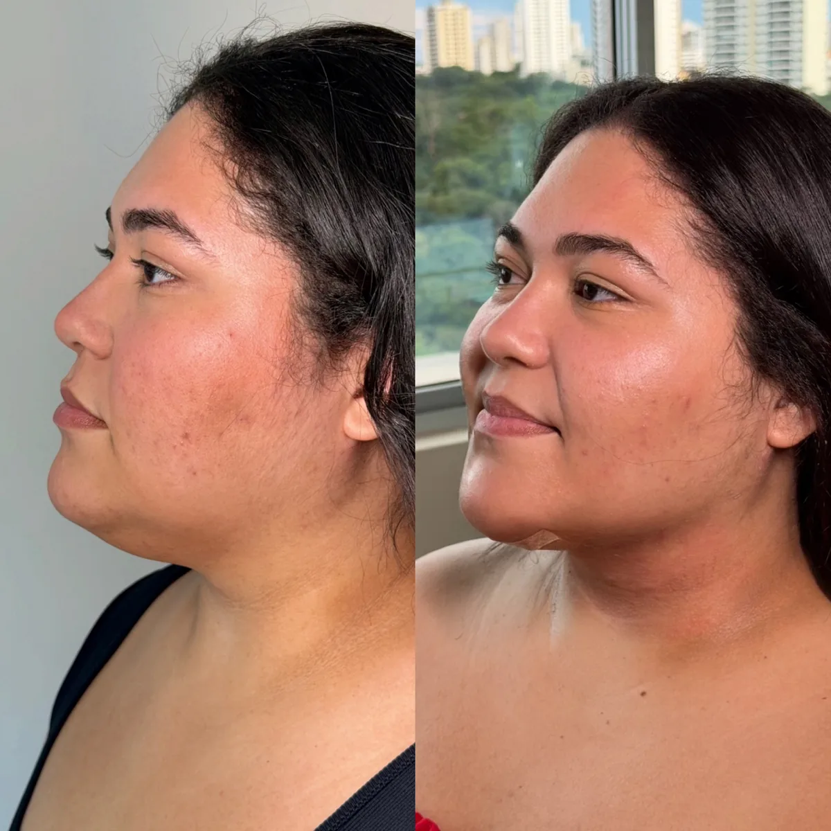 Contorno de queixo e pescoço antes e depois da lipo de papada