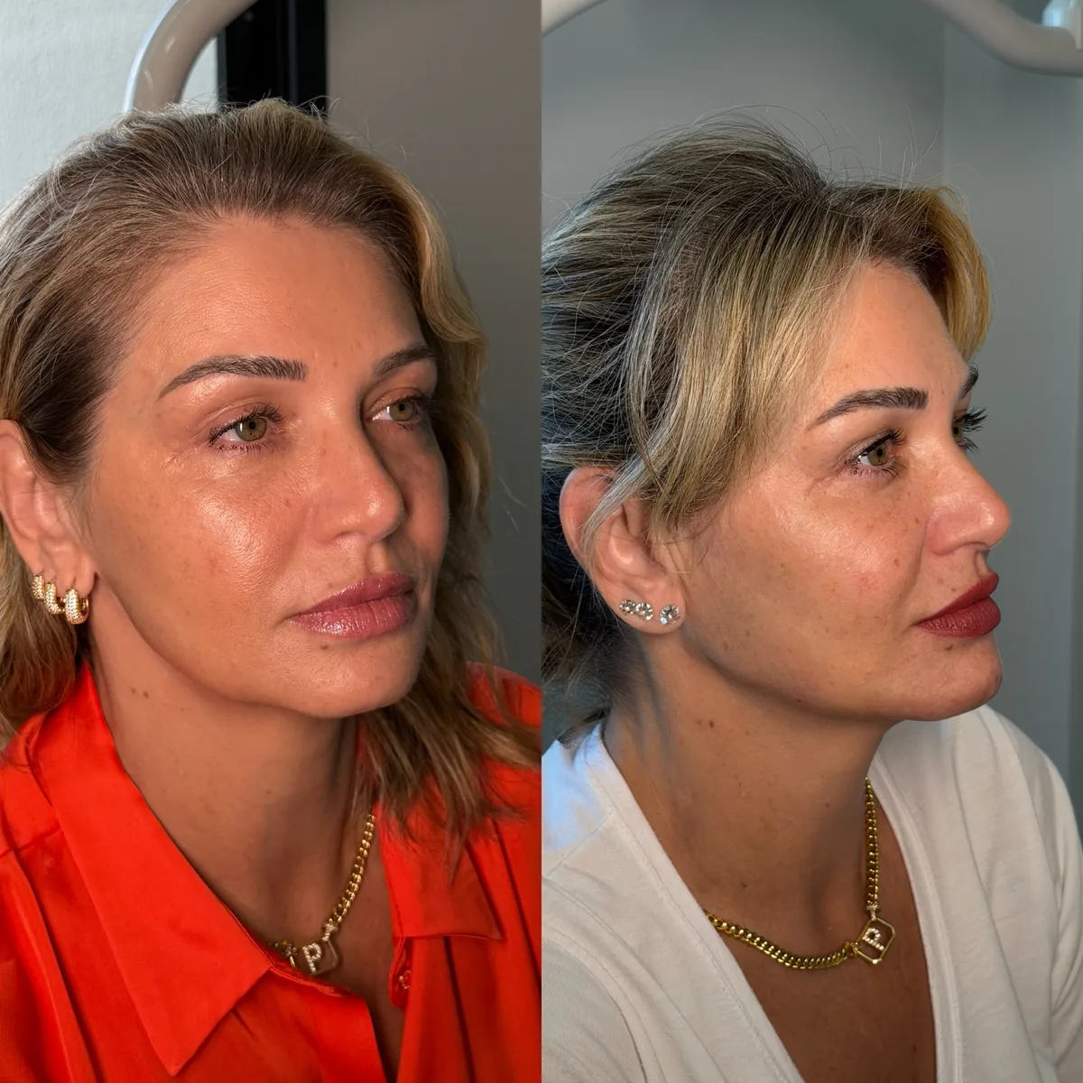 Harmonização facial antes e depois, vista de três quartos