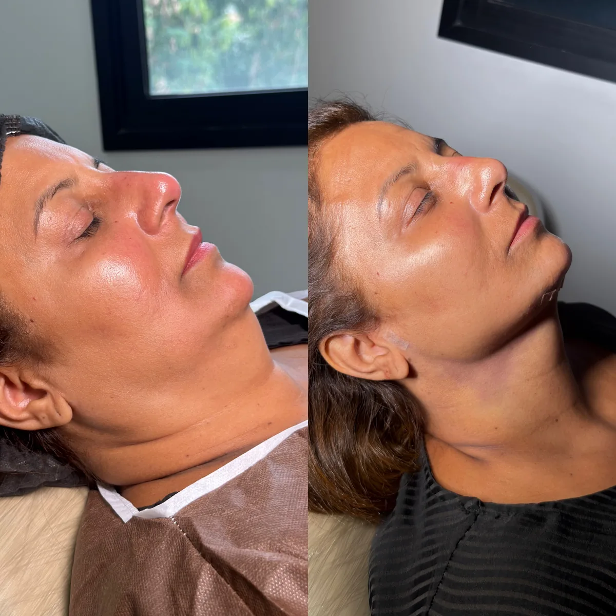 Contorno cervical antes e depois do tratamento